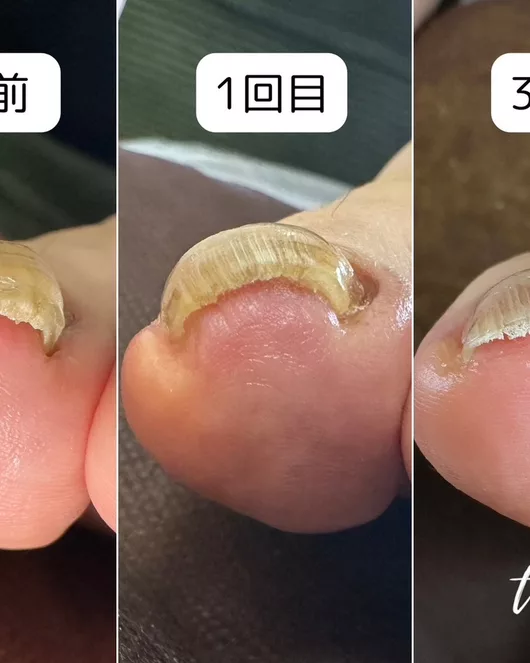 嵌甲护理体验